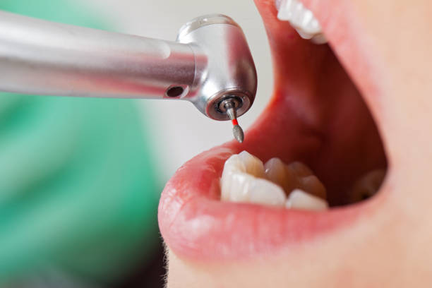 Best Chipped Tooth Repair Near Me  in Vine Grove, KY